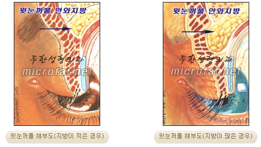 [두한성형외과 지방제거] - [눈밑지방제거, 윗눈꺼풀지방제거] 관련 이미지 52