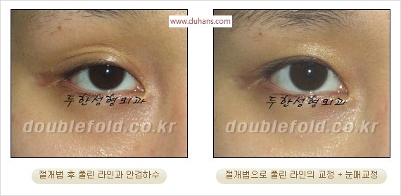 [두한성형외과 경쟁력 눈성형] - [쌍꺼풀 재수술에 대한 최선의 대안 제시] 관련 이미지 84