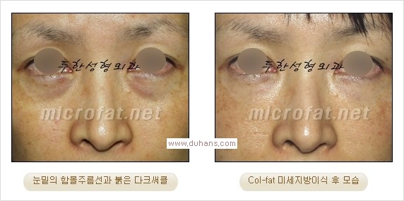 [두한성형외과 경쟁력 눈밑성형] - [눈밑이 전반적으로 함몰된 다크써클 교정 안내] 관련 이미지 9