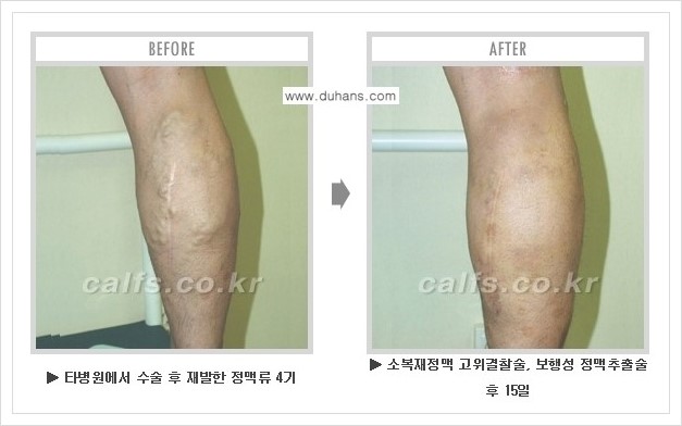 [두한성형외과 경쟁력 정맥류 치료] - [하지정맥류 사진 자료 안내 1.] 관련 이미지 13