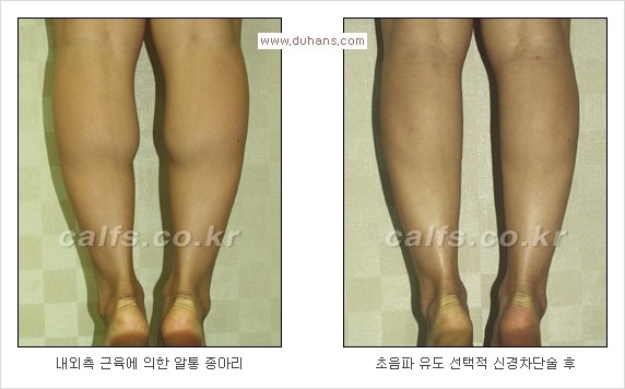 [두한성형외과 Dr. 컬럼] - [종아리 근육퇴축술로 가장 선호하는 비절개 초음파 유도 선택적 신경차단술] 관련 이미지 6