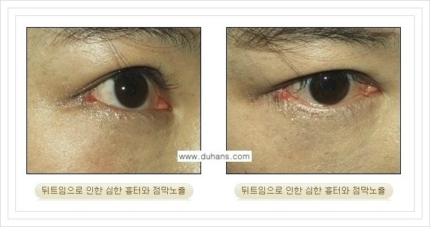 [두한성형외과 경쟁력 쌍꺼풀 재수술, 극한 눈재수술] - [뒤트임 수술 부작용과 위험성] 관련 이미지 1