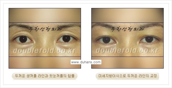 [두한성형외과 경쟁력 눈성형] - [미세지방이식으로 두껍고 어색한 라인 교정 안내 1.] 관련 이미지 10
