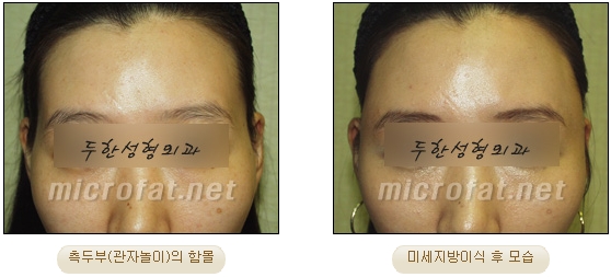 [두한성형외과 자가지방이식] - [관자놀이 교정] 관련 이미지 10
