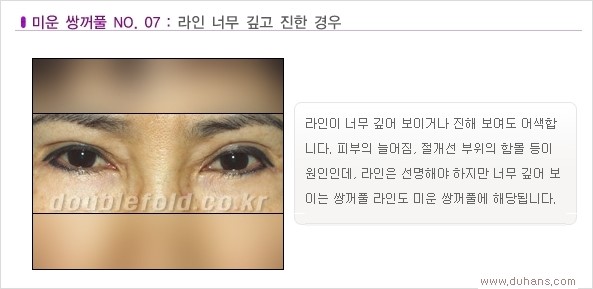 [두한성형외과 경쟁력 쌍꺼풀 재수술, 극한 눈재수술] - [Dr. 컬럼 - 재수술의 목표] 관련 이미지 10