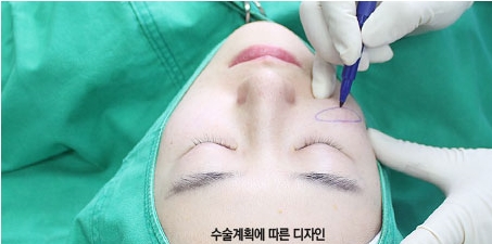 [눈밑수술 두한성형외과] - [다크서클 콤비프로그램] 관련 이미지 96
