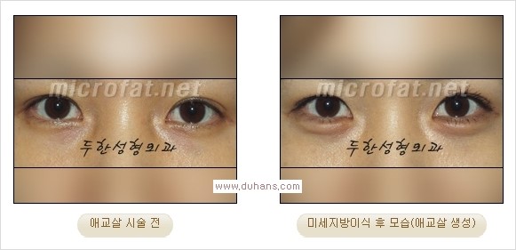 [두한성형외과 경쟁력 눈밑성형] - [타 병원 필러 애교살 시술 부작용을 미세지방이식으로 교정] 관련 이미지 23