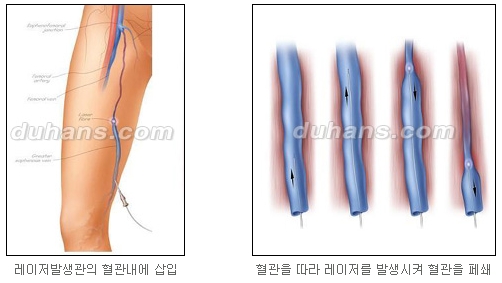 [두한성형외과 정맥류] - [정맥류 시술안내] 관련 이미지 12