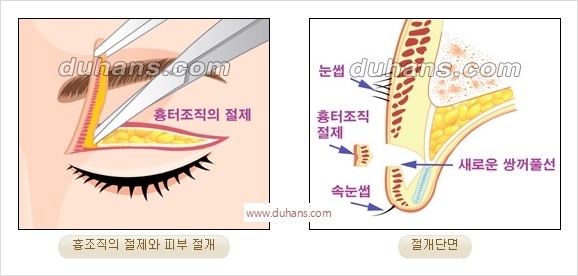 [두한성형외과 경쟁력 눈성형] - [완전절개법(Full incision method)의 재수술 과정] 관련 이미지 2