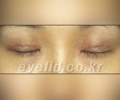Duhan Plastic Surgery Eye Surgery - Are You a Candidate for Double Eyelid Revision Surgery?! image 9