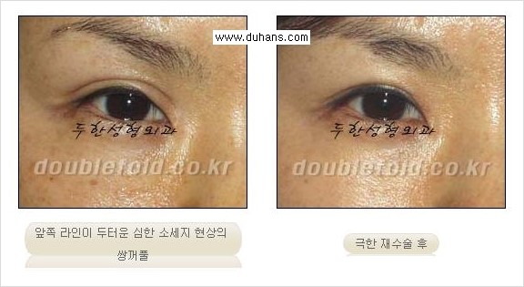[두한성형외과 경쟁력 쌍꺼풀 재수술, 극한 재수술] - [재수술에서 극복해야 할 극한의 상황과 문제들 안내] 관련 이미지 12