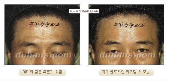 [두한성형외과 경쟁력 주름성형] - [눈썹거상, 앞볼처짐 개선의 엔도타인 리프팅] 관련 이미지 18