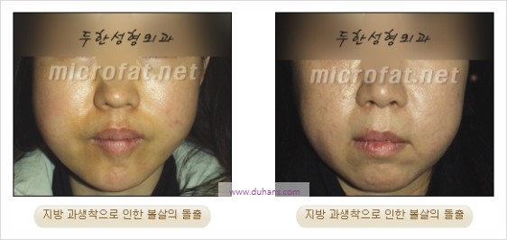 [두한성형외과 경쟁력 지방이식] - [두한 자가지방이식 클리닉 안내]​ 관련 이미지 54
