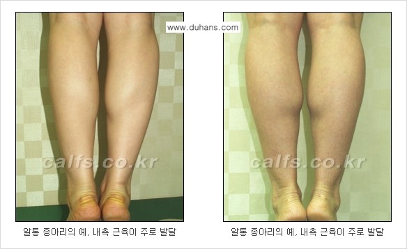 [두한성형외과] - [가을엔 아름답고 매끈한 다리 도전!​] 관련 이미지 4