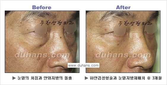 [두한성형외과의 상큼하고 환한 젊은 눈매완성] - [하안검 성형술 ②] 관련 이미지 29