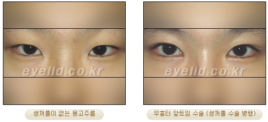 두한성형외과 몽고주름 제거 관련 이미지 10