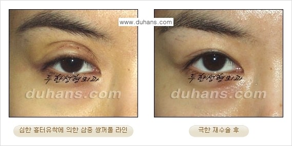 [두한성형외과 경쟁력 눈성형] - [두꺼운 라인을 교정하는 극한 눈 재수술 1.] 관련 이미지 8