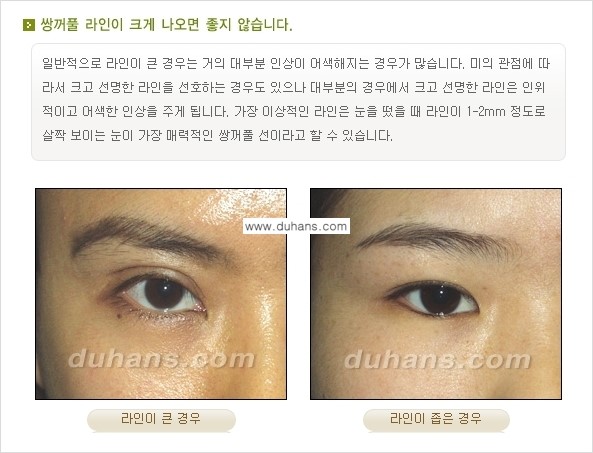 [두한성형외과 경쟁력 눈성형] - [매력적인 쌍꺼풀이란?] 관련 이미지 2