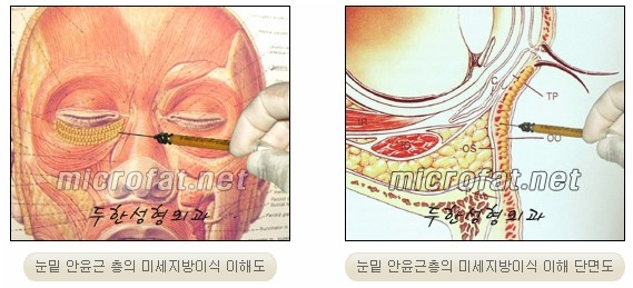 [두한성형외과 지방이식] - [다크서클, 눈밑주름] 관련 이미지 11