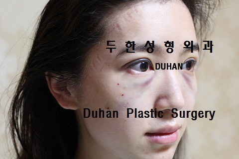 #눈밑수술 과 #쌍꺼풀 수술 , #눈밑지방이식 #인디언밴드 #앞광대주름 #눈물고랑 관련 이미지 4