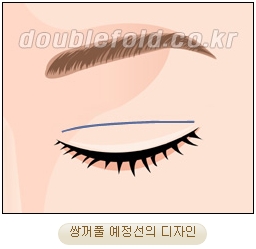 두한성형외과 쌍커풀재수술 - 삼중 쌍커풀 라인 교정 관련 이미지 5