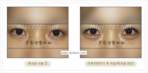 [두한성형외과 경쟁력 눈밑성형] - [애교살과 다크써클과의 관계] 관련 이미지 8