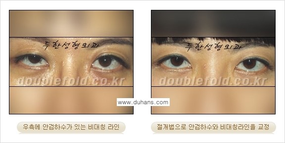 [두한성형외과 NO.1 "극한 눈(쌍꺼풀 재수술)"] - [안검하수(졸린눈매) 재수술 안내 3.] 관련 이미지 7