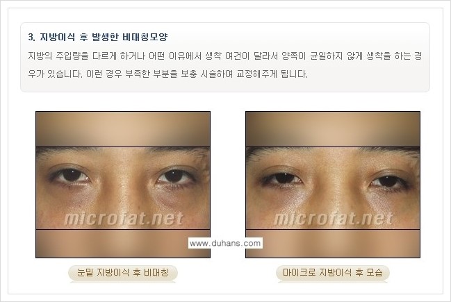 [두한성형외과 경쟁력 지방이식] - [지방이식 부작용 교정 안내 2.] 관련 이미지 10