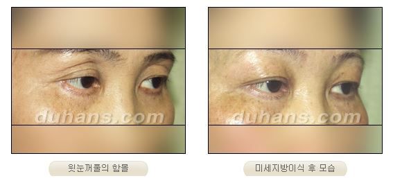 ✨눈 위 꺼짐, 단순 미용이 아닌 기능까지 고려해야 하는 이유✨ 관련 이미지 1