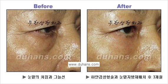 [두한성형외과의 상큼하고 환한 젊은 눈매완성] - [하안검 성형술 ②] 관련 이미지 12