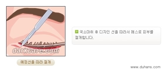 ​[두한성형외과 NO.1 다크써클 교정] - [하안검 성형술 + 눈밑지방 재배치] 관련 이미지 5