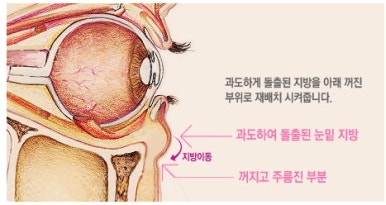[Duhan Plastic Surgery Dark Circles] - [Under-Eye Fat Repositioning] image 3