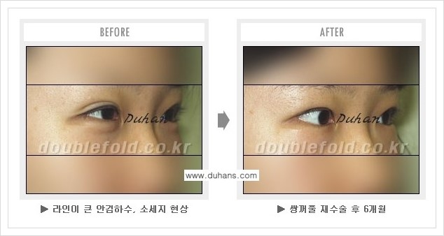 [두한성형외과 경쟁력 쌍꺼풀 재수술, 극한 눈재수술] - [과교정 된 눈매교정] 관련 이미지 4