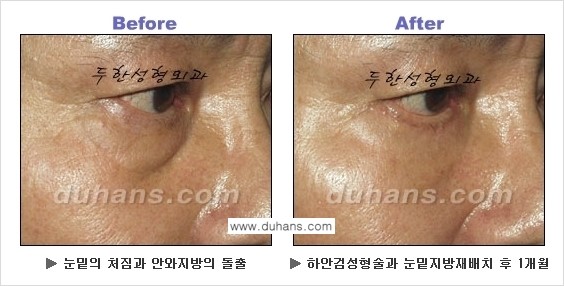 [두한성형외과의 상큼하고 환한 젊은 눈매완성] - [하안검 성형술 ①] 관련 이미지 14
