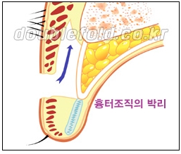 [두한성형외과 쌍수] - [재수술 실패의 원인, 재수술의 성공 요건] 관련 이미지 4