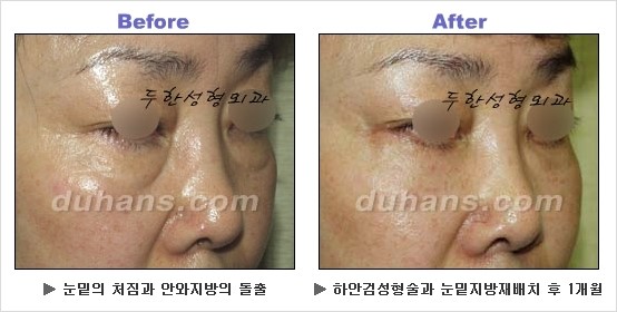 [두한성형외과 경쟁력 동안성형 리더] - ​[미간주름, 이마주름, 안검성형, 이마거상술, 눈썹거상술] 관련 이미지 88