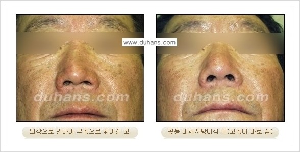 [두한성형외과 경쟁력 코성형] - [미세지방이식 코성형 안내] 관련 이미지 3