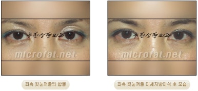 [Doohan Plastic Surgery Autologous Fat Grafting] - [Sunken Eye Fat Grafting] image 35