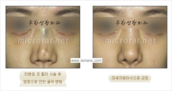 [두한성형외과 경쟁력 Quick성형] - [주름교정을 위한 필러 시술] 관련 이미지 13