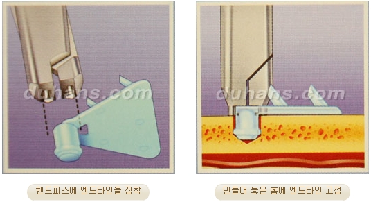 두한성형외과 안티에이징 리프팅 - 엔도타인 리프팅 관련 이미지 22