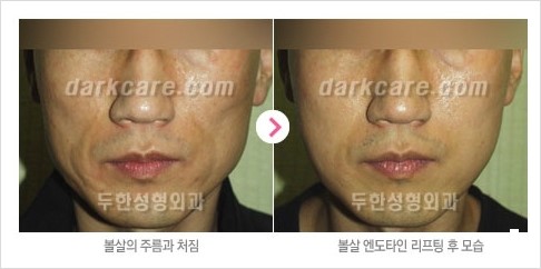 [두한성형외과 경쟁력 주름성형] - [주름제거를 위한 리프팅] 관련 이미지 23