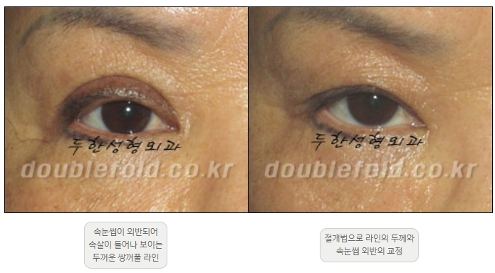 [Double Eyelid Surgery Duhan Plastic Surgery] - [Revision Methods] image 37