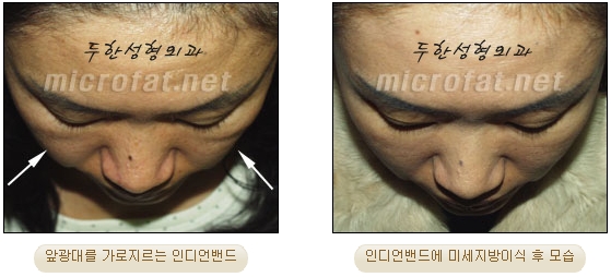 [Duhan Plastic Surgery Face Autologous Fat Grafting] - [Noble Surgery and Indian Band Fat Grafting] image 21