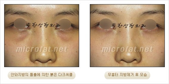 [두한성형외과 쌍커풀수술] - [눈성형 방법에 대한 자주하는 질문과 답변] 관련 이미지 181