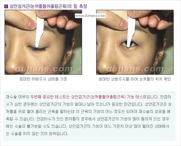 [두한성형외과 경쟁력 쌍꺼풀 재수술, 극한 눈재수술] - [재수술에 대한 최선의 대안 제시] 관련 이미지 10