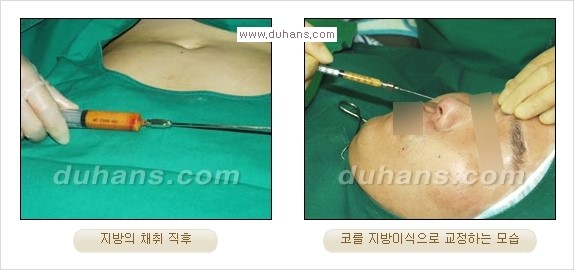 [두한성형외과 경쟁력 코성형] - [실리콘, 알로덤, 미세지방이식을 이용한 맞춤 코성형] 관련 이미지 16