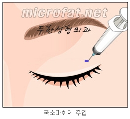[두한성형외과 지방제거] - [눈밑지방제거, 윗눈꺼풀지방제거] 관련 이미지 54