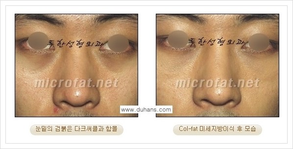 [두한성형외과 경쟁력 눈밑성형] - [눈밑 다크써클과 눈밑 함몰주름의 최적화 교정방법 안내] 관련 이미지 7