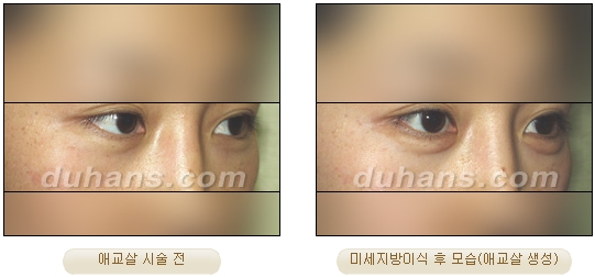 Duhan Plastic Surgery Under-Eye Surgery - Correction with Fat Grafting After Aegyo-Sal Filler image 9