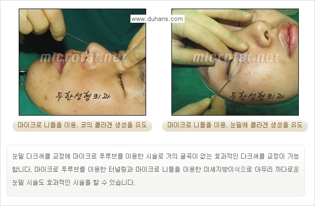 [두한성형외과 경쟁력 미세지방이식] - [Col-fat(콜펫) 지방이식의 특징과 차이점 안내] 관련 이미지 3